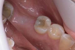 Placa de Proteção Alveolar para Implantes / Dr. Marcio Baltazar Conz