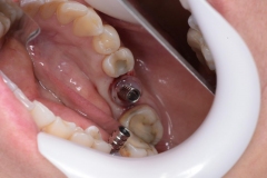 Placa de Proteção Alveolar para Implantes / Dr. Marcio Baltazar Conz