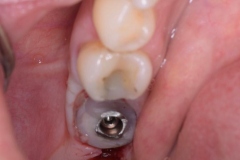 Placa de Proteção Alveolar para Implantes / Dr. Marcio Baltazar Conz