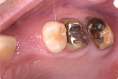 Placa de Proteção Alveolar para Implantes / Dr. Marcio Baltazar Conz