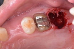 Placa de Proteção Alveolar para Implantes / Dr. Marcio Baltazar Conz