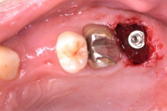 Placa de Proteção Alveolar para Implantes / Dr. Marcio Baltazar Conz