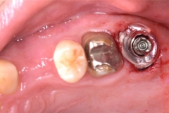 Placa de Proteção Alveolar para Implantes / Dr. Marcio Baltazar Conz