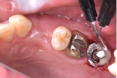 Placa de Proteção Alveolar para Implantes / Dr. Marcio Baltazar Conz