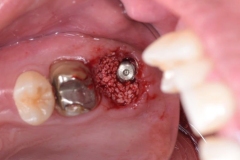 Placa de Proteção Alveolar para Implantes / Dr. Marcio Baltazar Conz