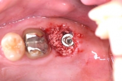 Placa de Proteção Alveolar para Implantes / Dr. Marcio Baltazar Conz
