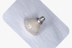 Placa de Proteção Alveolar para Implantes / Dr. Marcio Baltazar Conz