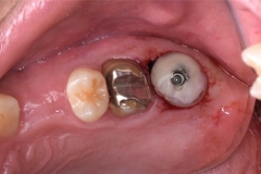 Placa de Proteção Alveolar para Implantes / Dr. Marcio Baltazar Conz