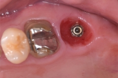 Placa de Proteção Alveolar para Implantes / Dr. Marcio Baltazar Conz