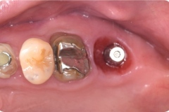 Placa de Proteção Alveolar para Implantes / Dr. Marcio Baltazar Conz