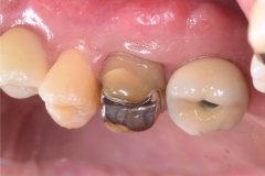 Placa de Proteção Alveolar para Implantes / Dr. Marcio Baltazar Conz