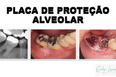 Placa de Proteção Alveolar Simples Dra Evelyn Lacerda