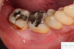 Placa de Proteção Alveolar Simples Dra Evelyn Lacerda