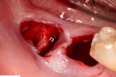 Placa de Proteção Alveolar Simples Dra Evelyn Lacerda