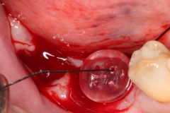 Placa de Proteção Alveolar Simples Dra Evelyn Lacerda