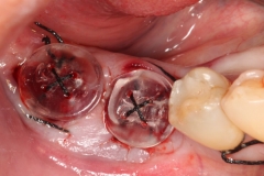 Placa de Proteção Alveolar Simples Dra Evelyn Lacerda