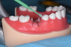 Placa de Proteção Alveolar com Haste / PPAH 7