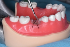 Placa de Proteção Alveolar com Haste / PPAH sutura