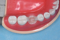 Placa de Proteção Alveolar com Haste / PPAH 3