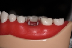 Placa de Proteção Alveolar com Haste / PPAH 2