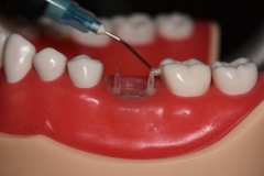 Placa de Proteção Alveolar com Haste / PPAH 1