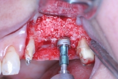 10-inserção-dos-implantes