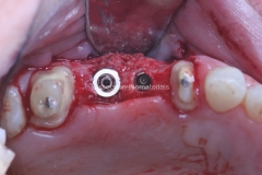 11-implantes-inseridos