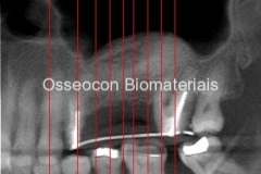 3-Tomografia-6-meses-após