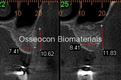 4-Tomografia-6-meses-após-2