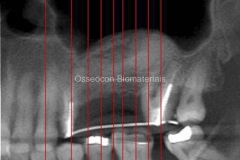 Tomografia-de-seio-maxilar-6-meses-após-enxerto-com-Alobone-Poros-2